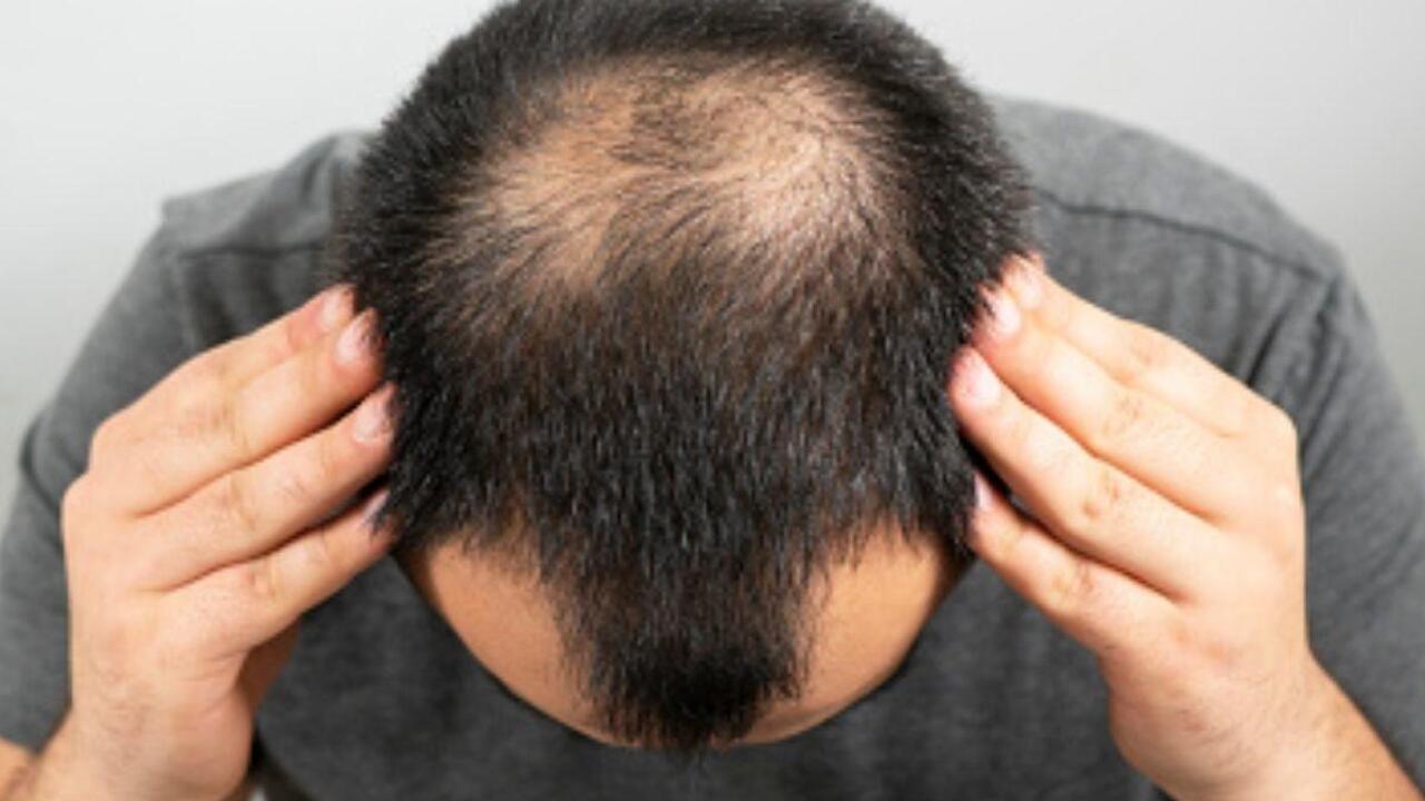 Bald Hair : టోపీ పెట్టుకుంటే బట్టతల వస్తుందా…నిజమేనా..?