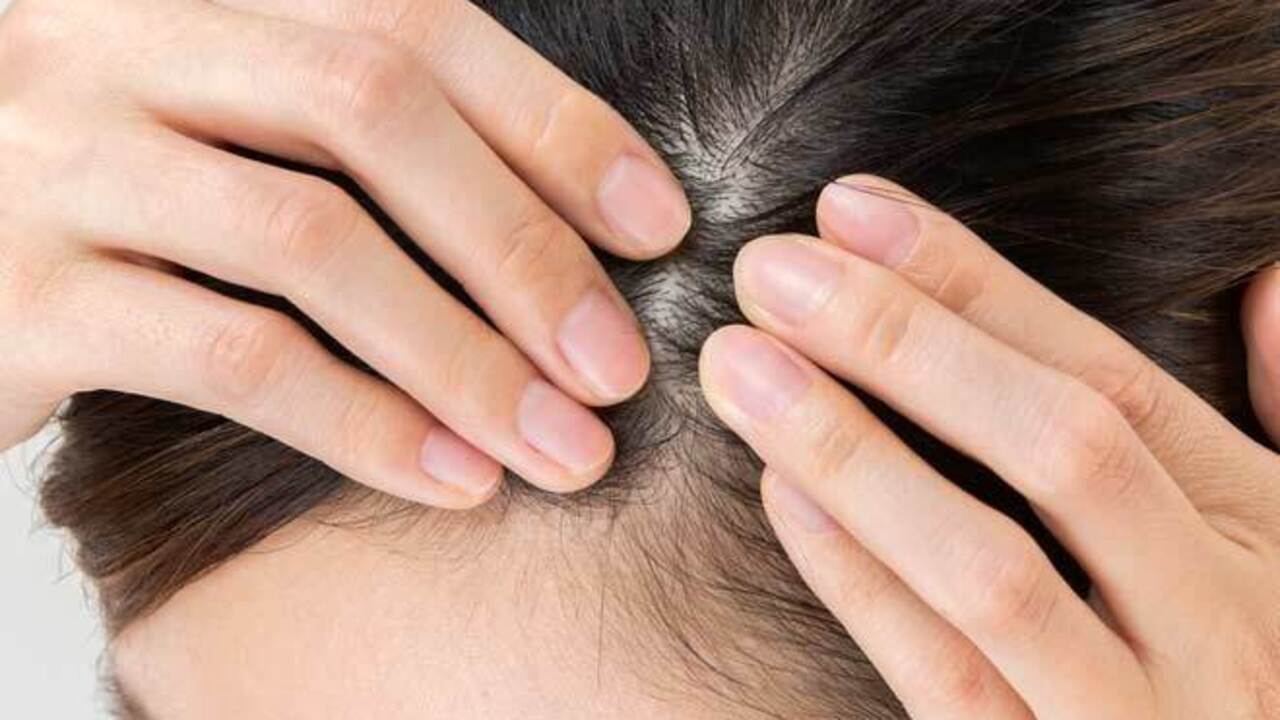 Thin Hair: జుట్టు పలచబడిందా..? ఈ చిట్కాలు పాటించి చూడండి..!!