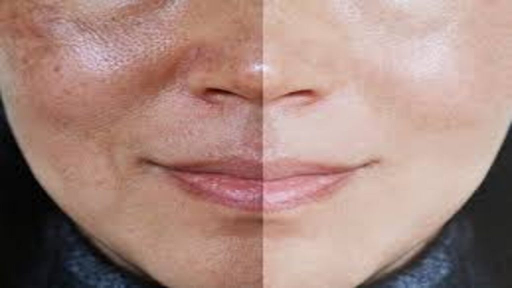 Hyyperpigmentation