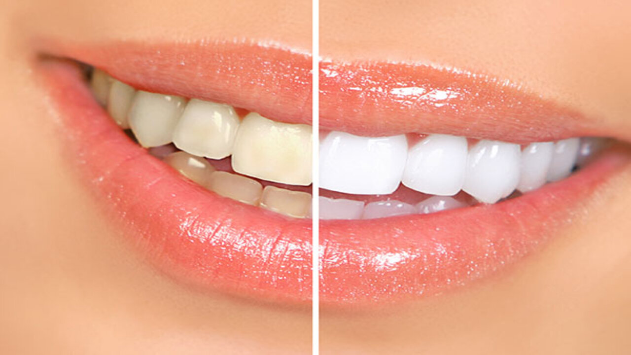 Shining Teeth Tips: దంతాలు పసుపు రంగులో ఉన్నాయా.. అయితే ఈ వంటింటి చిట్కాలు మీకోసమే?