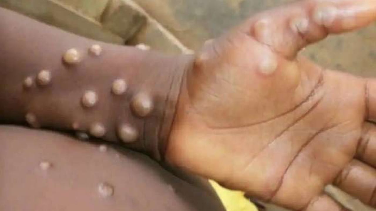 Monkeypox : ఢిల్లీలో నాలుగు చేరిన మంకీపాక్స్ కేసులు… దేశ వ్యాప్తంగా 9 కేసులు న‌మోదు