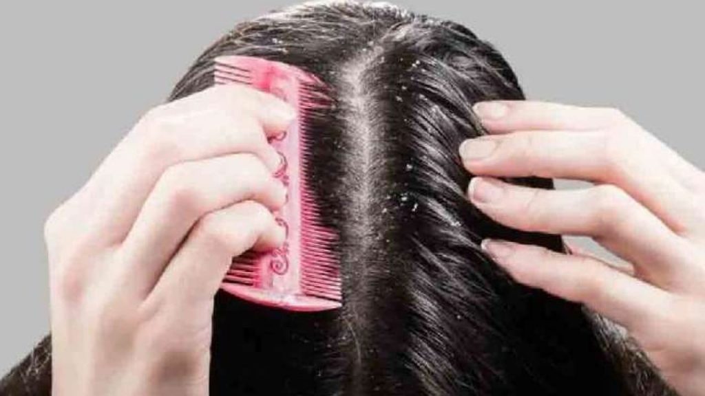Dandruff