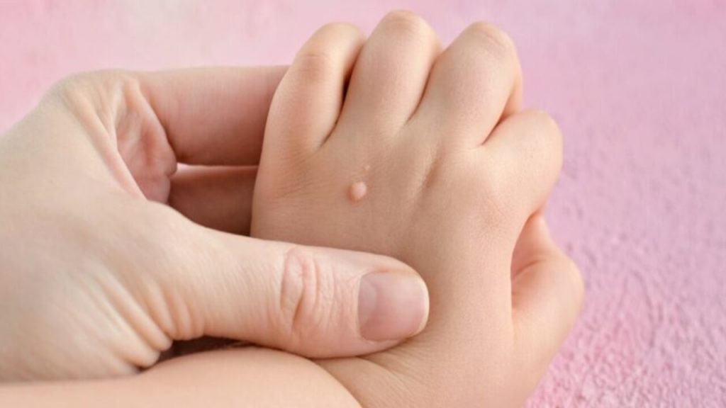 Skin Tags
