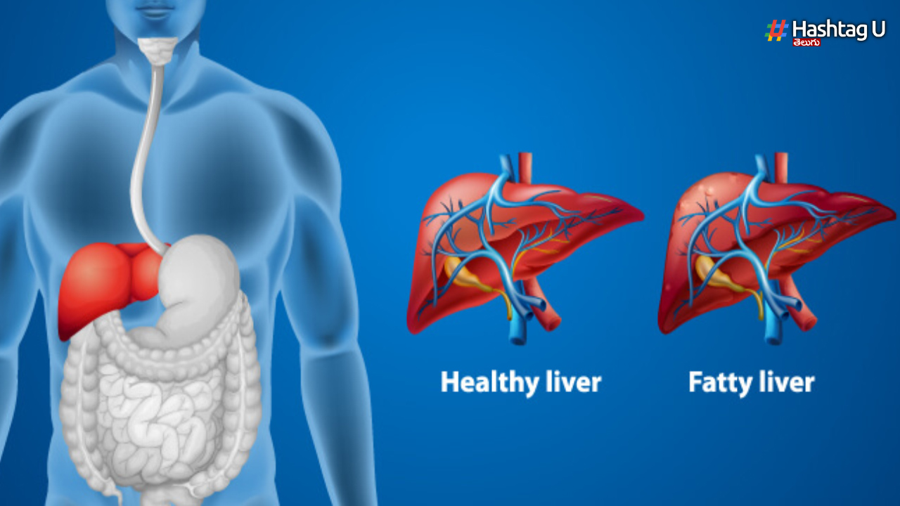 Fatty Liver Symptoms: ఫ్యాటీ లివర్ అంటే ఏమిటి..? దాని ల‌క్ష‌ణాలు, చికిత్స మార్గాలు ఇవే..!