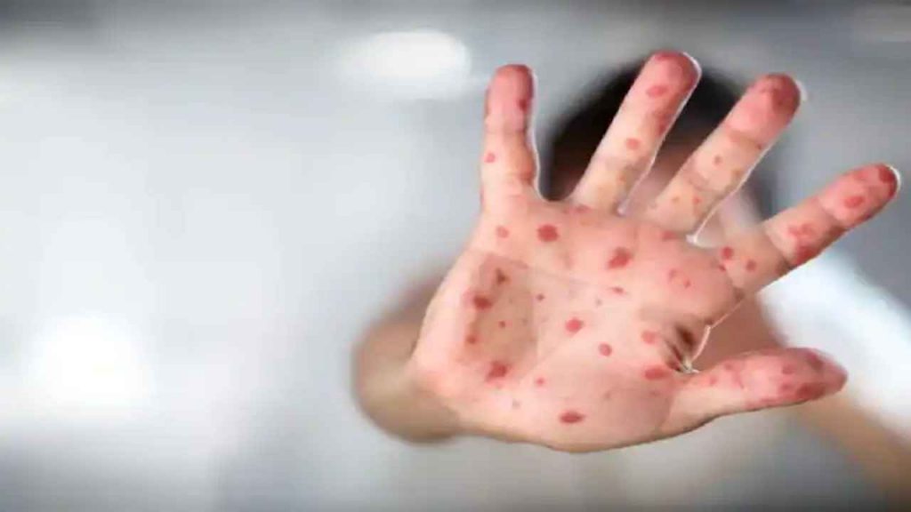 Measles