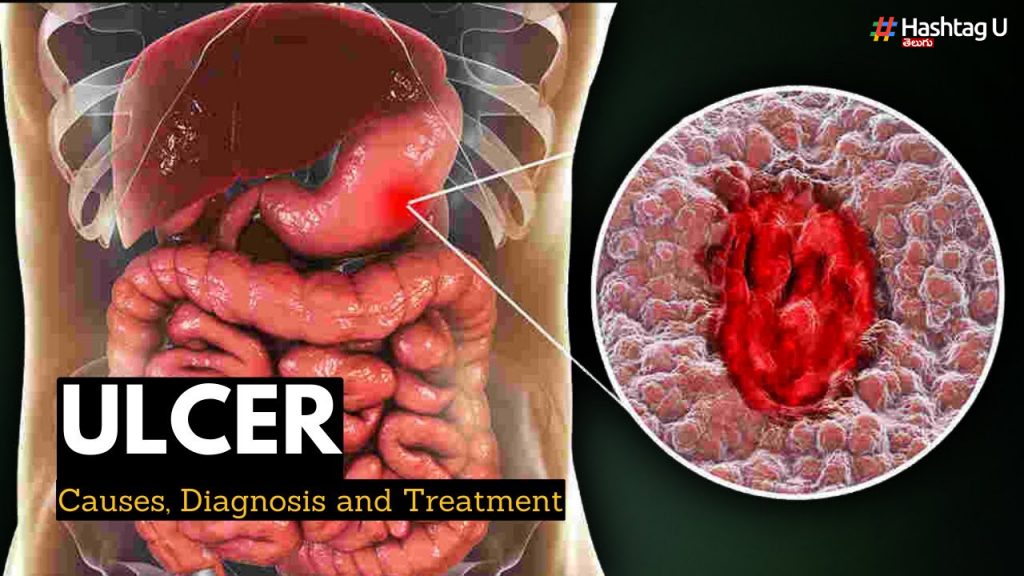 Flaky Ulcers.. Causes, Solutions