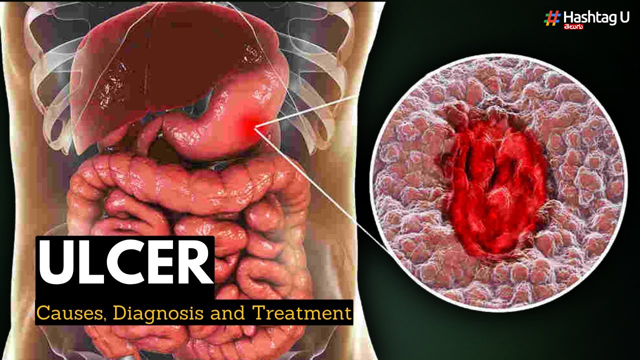 Ulcers: అల్లాడించే అల్సర్స్.. కారణాలు, పరిష్కారాలు