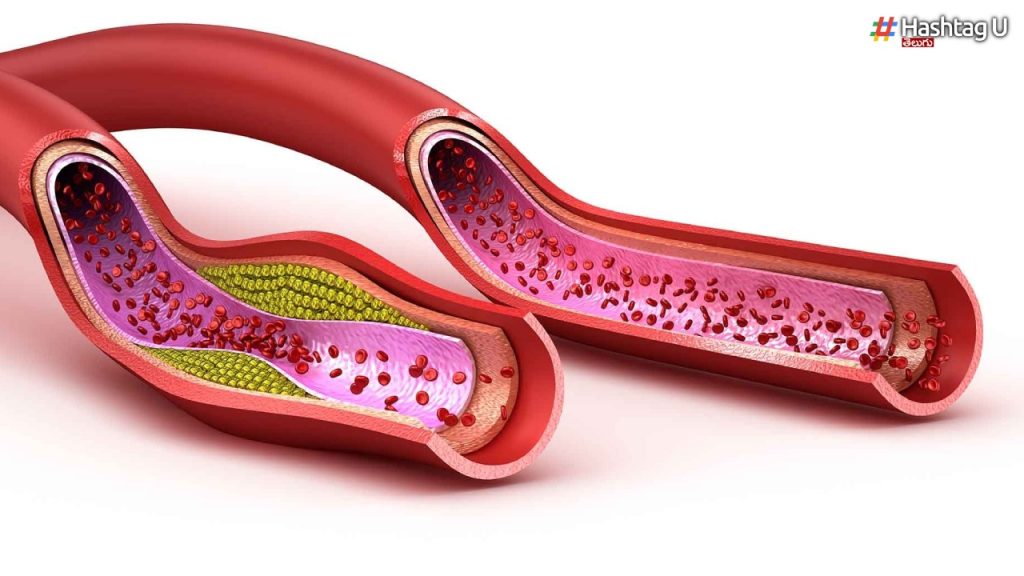 If You Follow These Tips, High Cholesterol Will Melt Away Quickly.