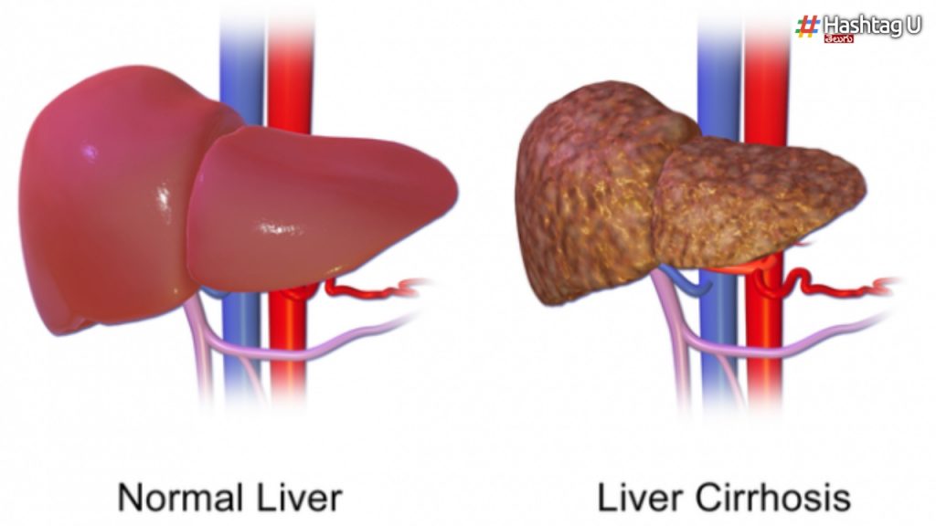 Liver Cirrhosis Problem Can Be Removed With These Ayurvedic Herbs.