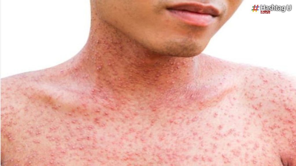 These Are The Tips To Prevent Chickenpox In Summer..!