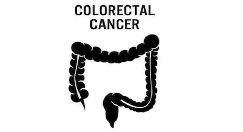 Colon Cancer: కొలోన్ క్యాన్సర్ సంకేతాలు ఇవీ..