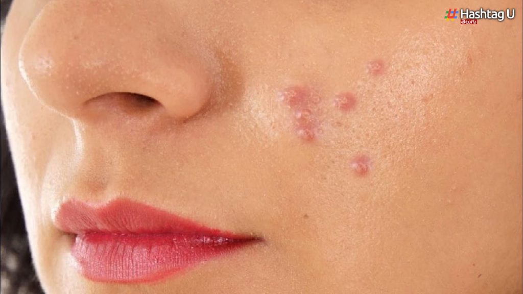 Scared of acne? This can be avoided.