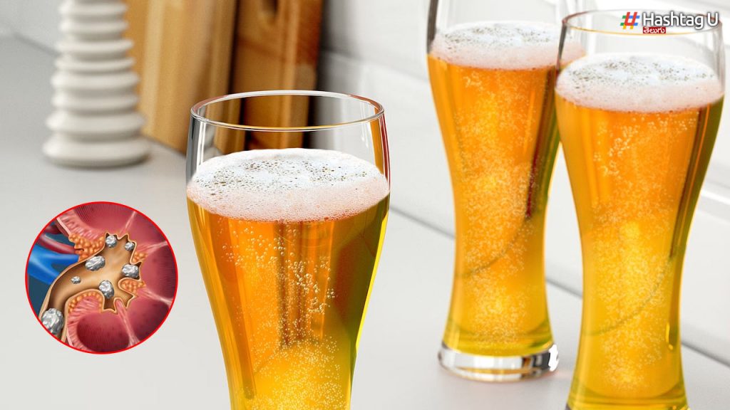 Drinking Beer Reduces Kidney Stones..!