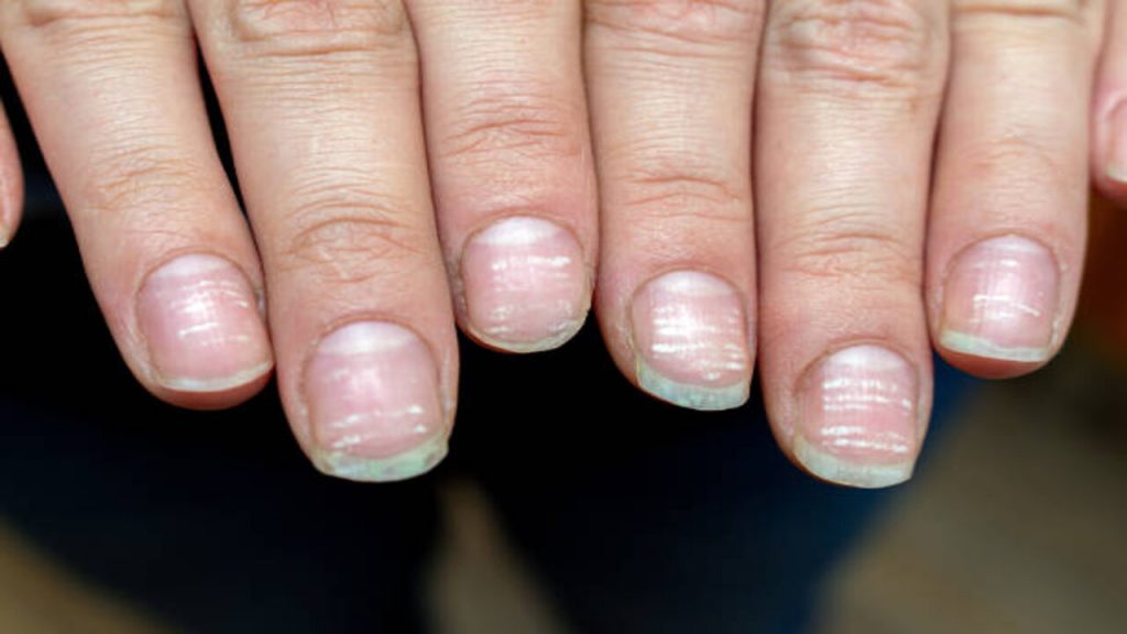 Vitamin Deficiency Avitaminosis Anemia Nail Problem With White Dots