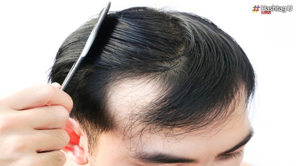 What Are The Causes Of Early Baldness..