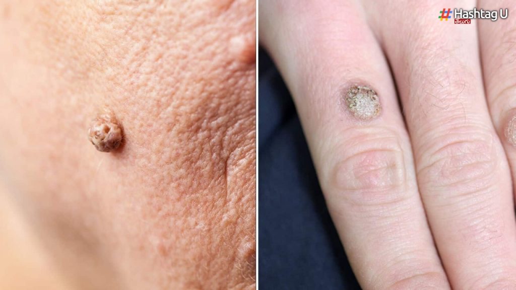 Why Do Skin Tags And Warts Occue How To Lose