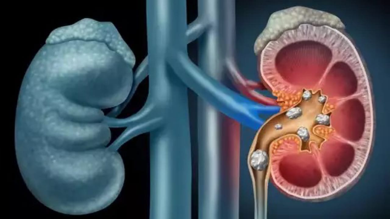 Kidney Stones: కిడ్నీలో రాళ్లను కరిగించే 7 రకాల పానీయాలు.. అవేంటంటే?
