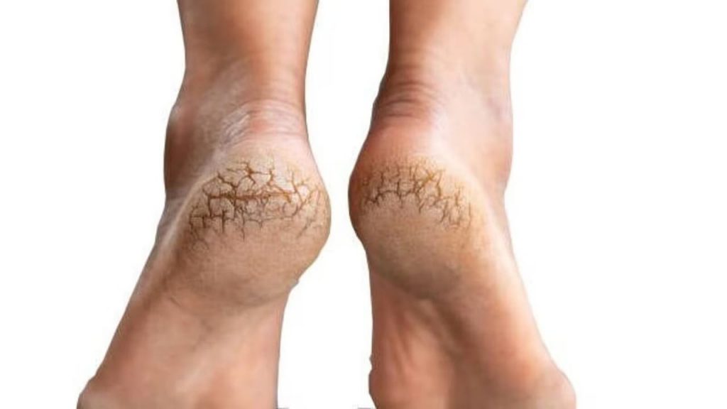 Cracked Heels