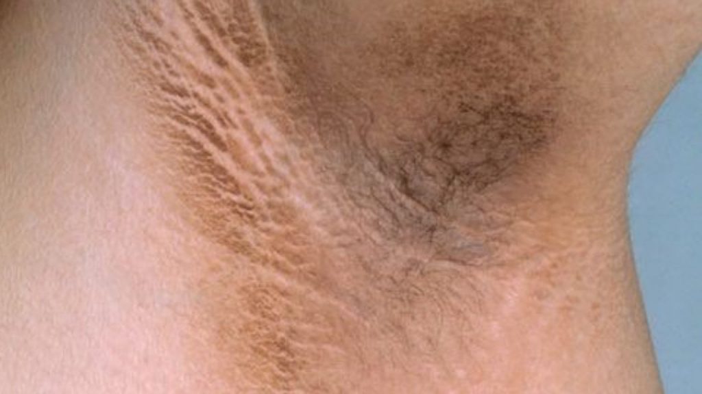 Dark Underarms