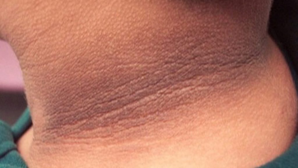 Dark Neck Remedies