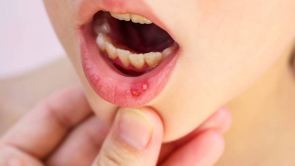 Mouth Ulcer