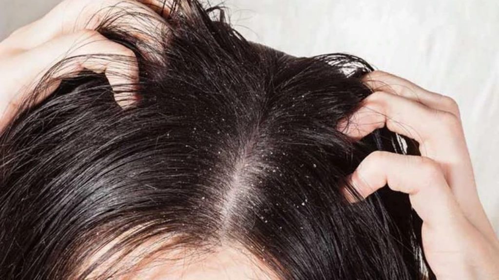 Dandruff