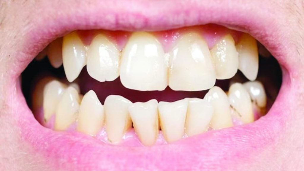 Teeth Tips