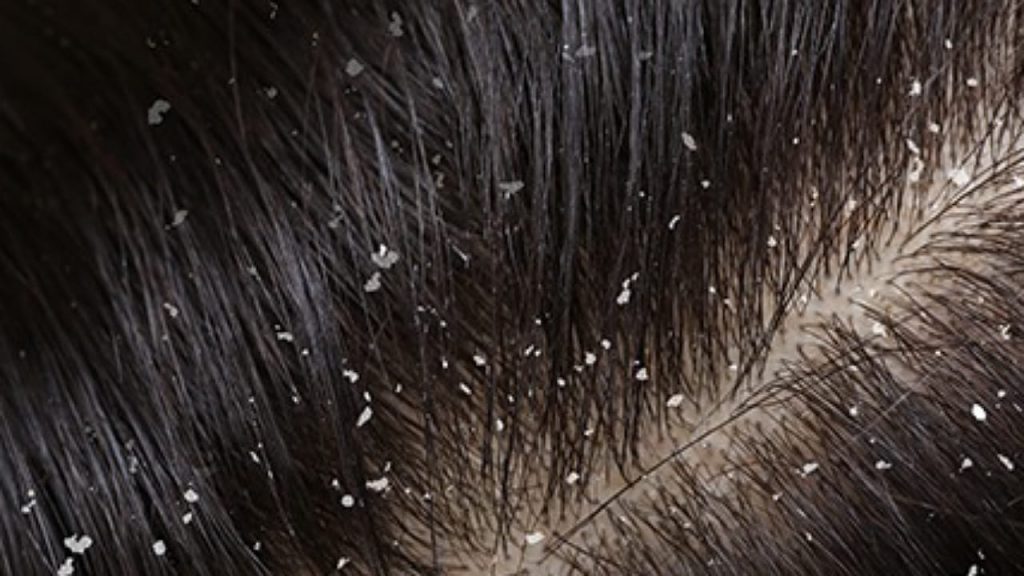 Tips To Remove Dandruff