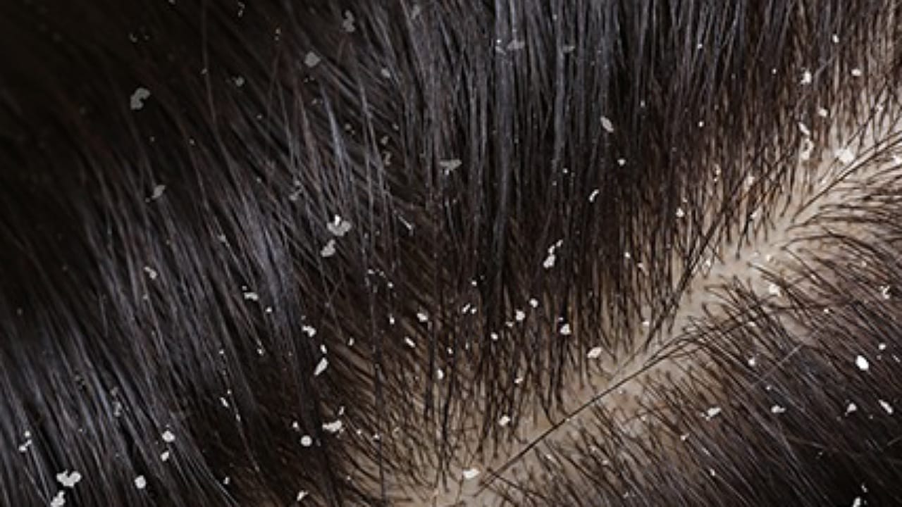 Tips To Remove Dandruff: డ్యాండ్రఫ్ సమస్యతో ఇబ్బంది పడుతున్నారా.. అయితే ఈ టిప్స్ పాటించాల్సిందే?