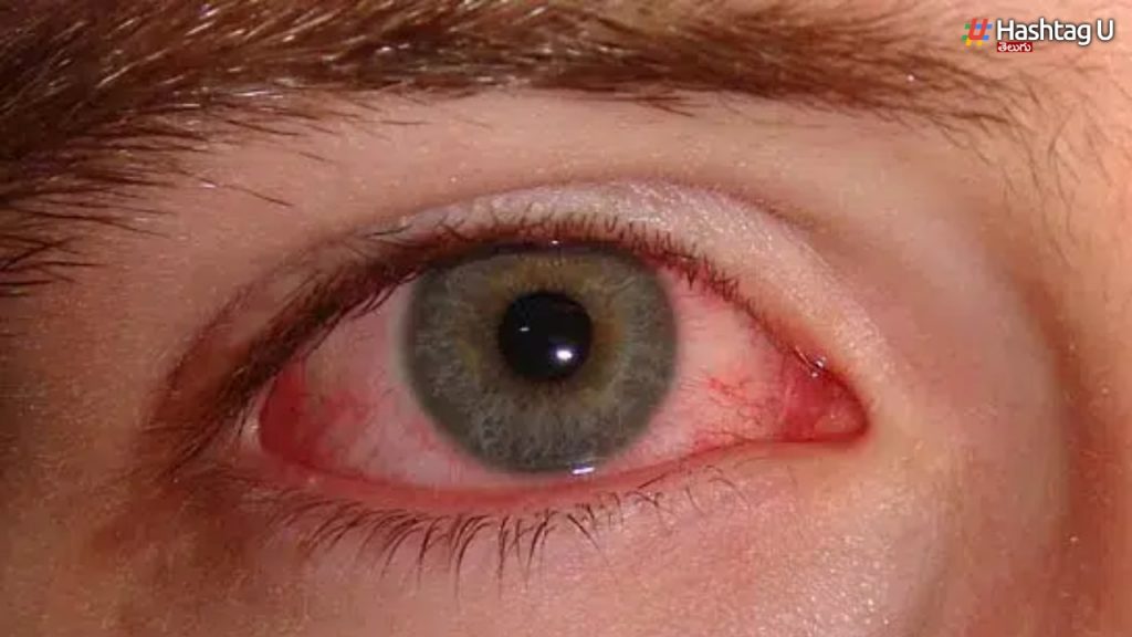 Conjunctivitis