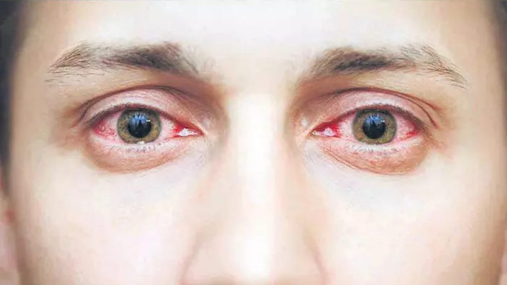 Conjunctivitis