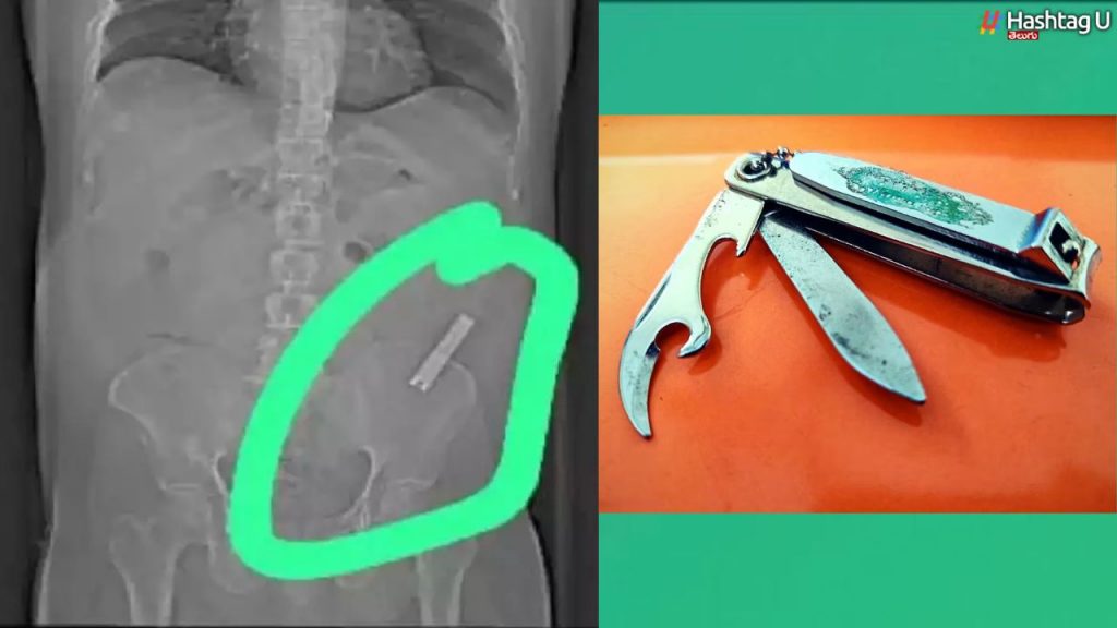 Nail Cutter In Stomach