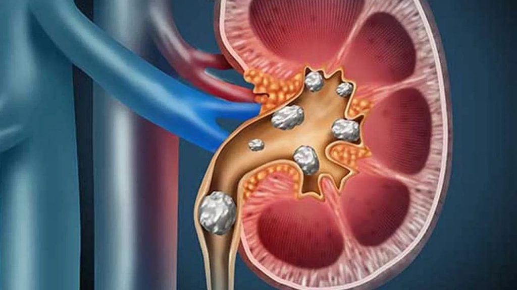 Kidney Stones