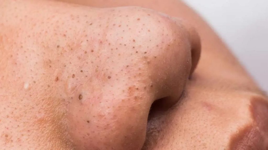 Blackheads Removal Tips