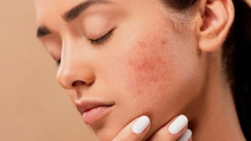 Dry Skin