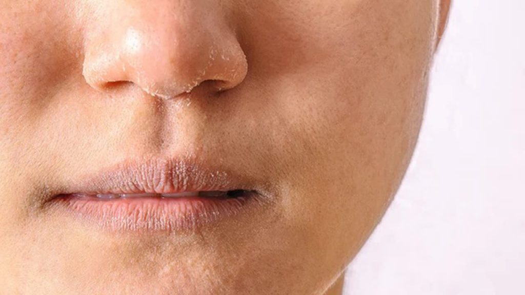 Dry Skin