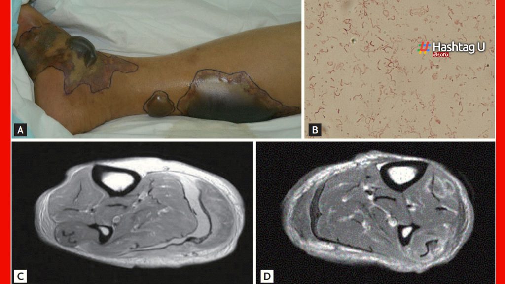 Vibrio Vulnificus