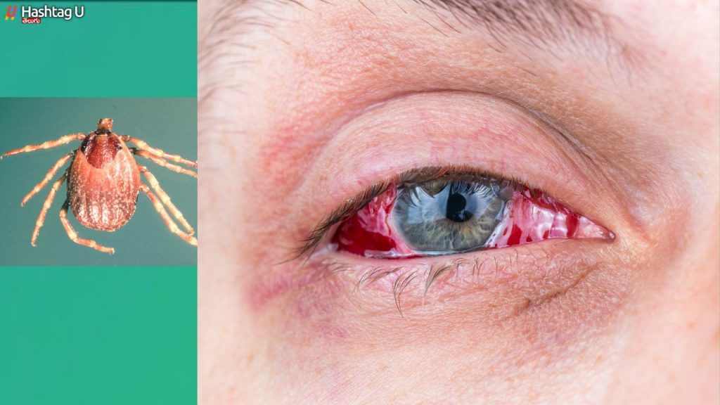 Eye Bleeding Fever