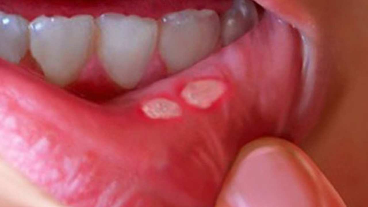Mouth Ulcers : నోటి పుండ్లను తగ్గించుకోవడానికి ఇంటి చిట్కాలు ఫాలో అవ్వండి..