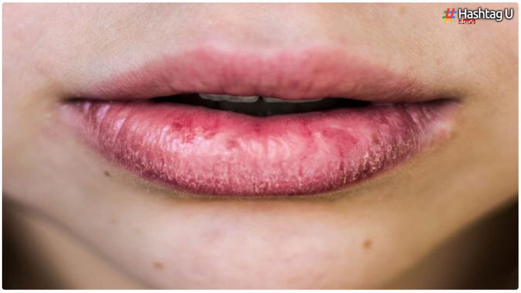 Are You Suffering From Chapped Lips In Winter.. But These Tips Should Be Used..