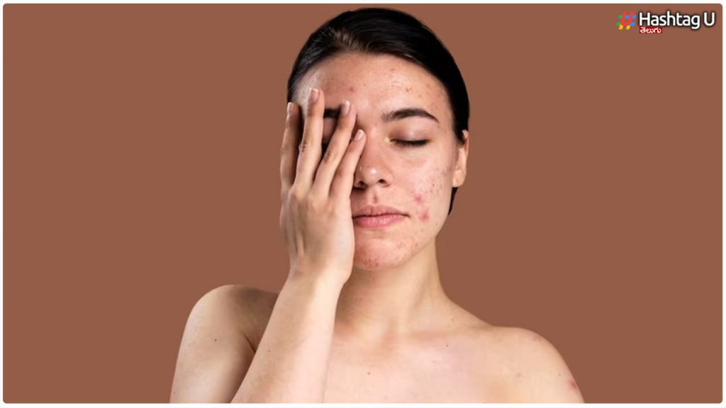 Are You Troubled By The Problem Of Acne Scars.. But Should You Do This..