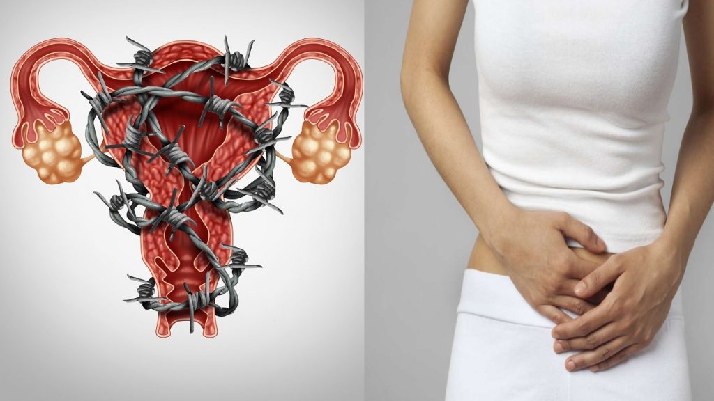 endometriosis
