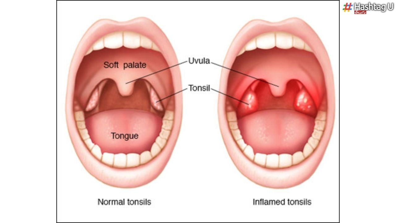 Tonsils : టాన్సిల్స్‌ వేధిస్తున్నాయా ? ఆయుర్వేద టిప్స్ ఇవిగో