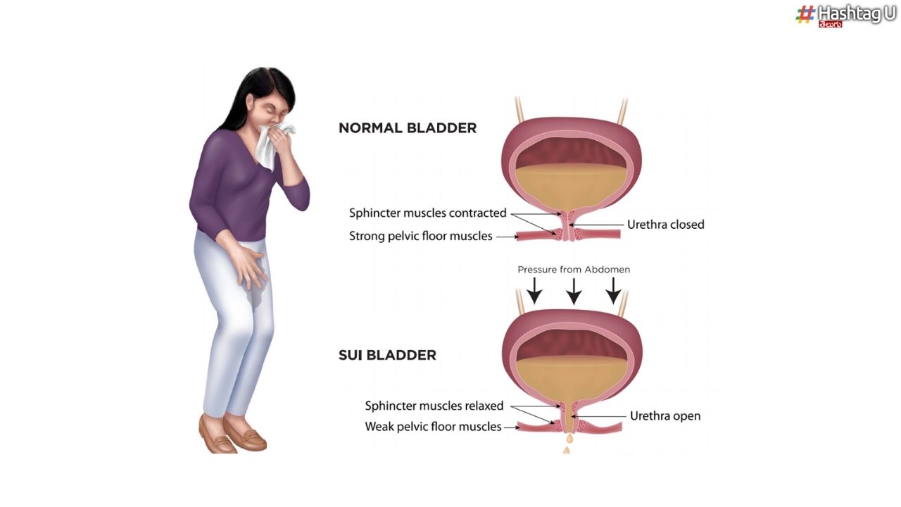 Urinary Incontinence : మూత్రం లీక్.. కారణాలేమిటి ? కంట్రోల్ ఎలా ?