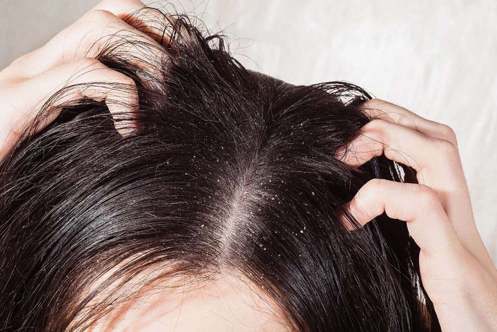 Packs Get Rid of Dandruff: చుండ్రు సమస్యతో ఇబ్బంది పడుతున్నారా.. అయితే ఈ హెయిర్ ప్యాక్స్ ట్రై చేయాల్సిందే?