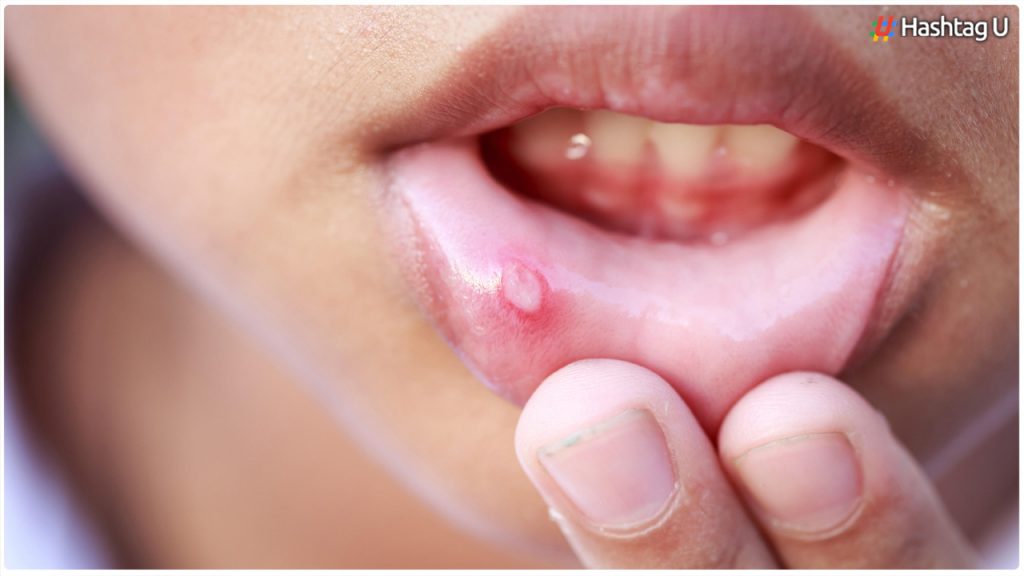 Are You Suffering From Mouth Ulcers.. But These Simple Tips Should Be Followed..