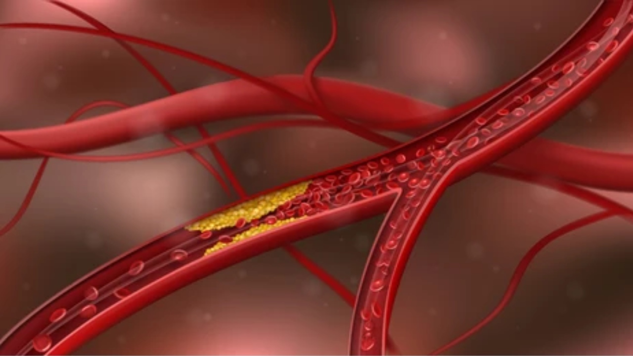 Cholesterol : అధిక కొలెస్ట్రాల్ను తగ్గించడానికి సులభమైన ఆయుర్వేద చిట్కాలు