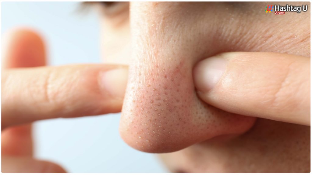Follow These Simple Tips To Remove Blackheads And Whiteheads Without Pain.