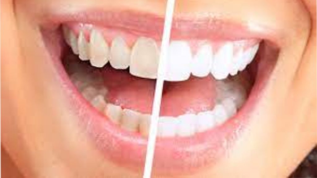 Teeth Whiten