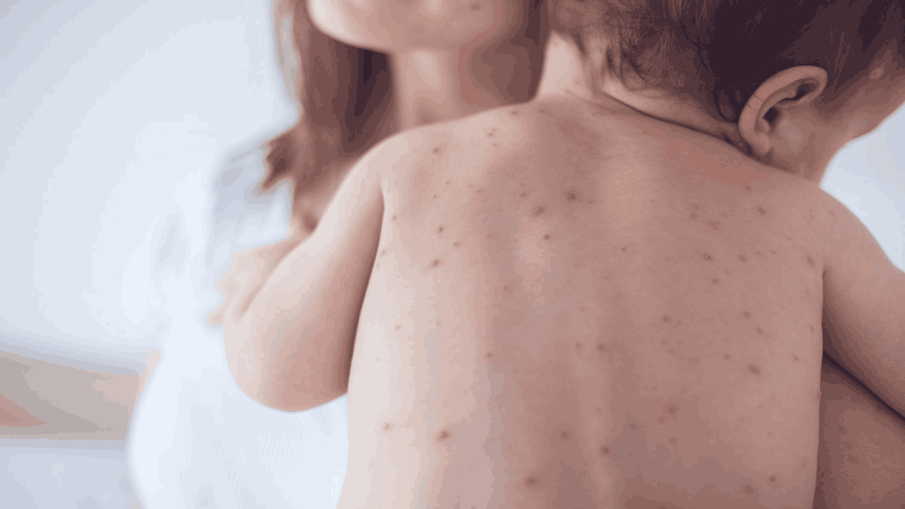 Measles Outbreak: మీజిల్స్ వ్యాధి అంటే ఏమిటి..? ల‌క్ష‌ణాలు ఇవే..!